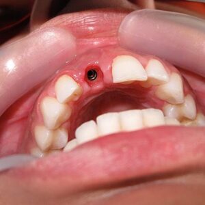 کاشت ایمپلنت دندان به روش پانچ و لیزر